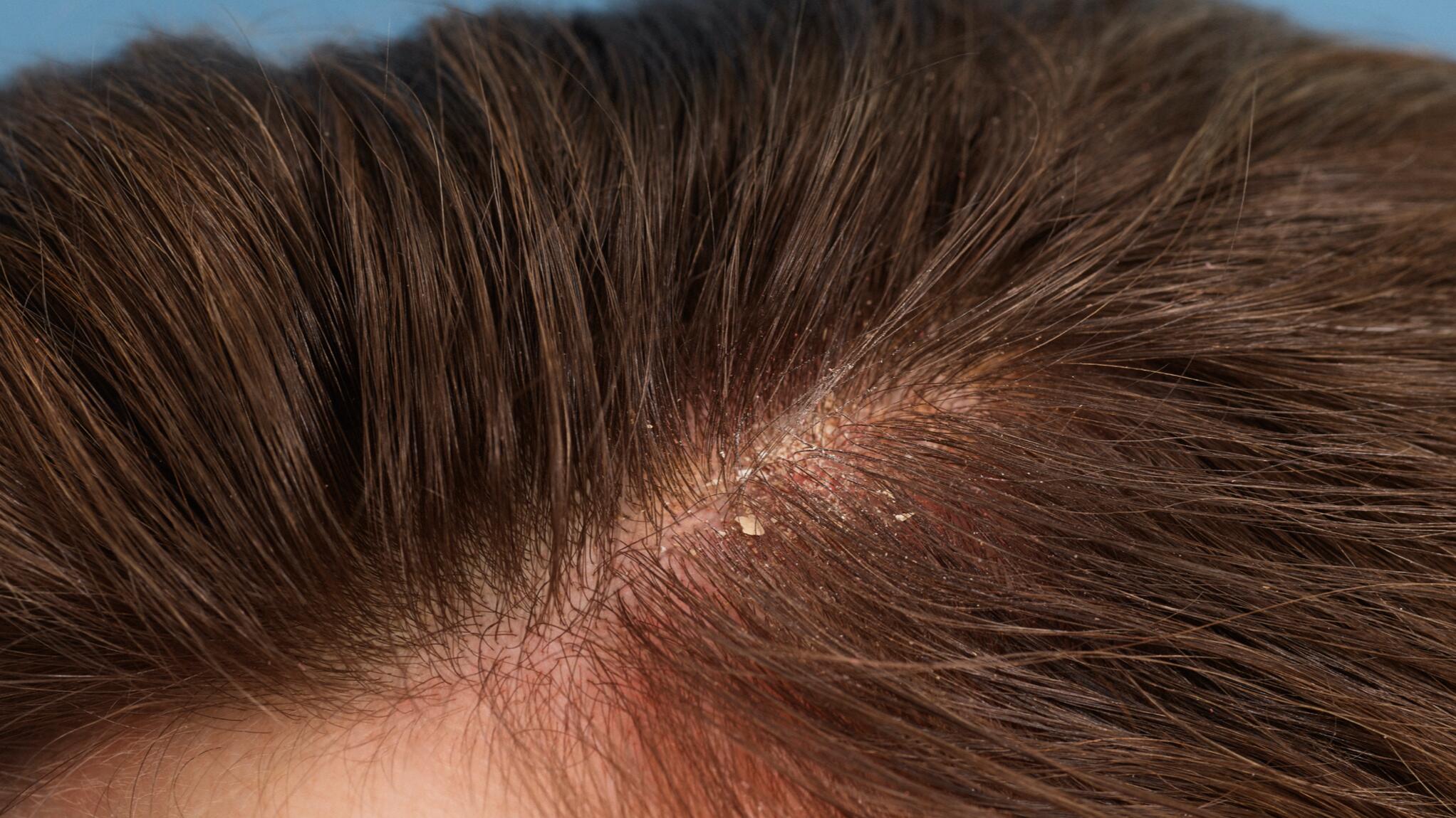 Seborrheic dermatitis of the scalp